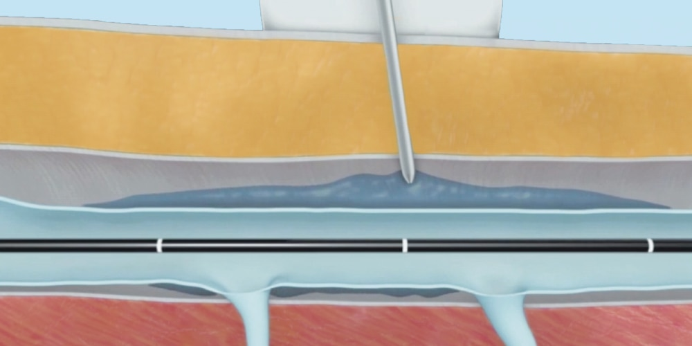 Helyi érzéstelenítés ClosureFast visszérműtét során