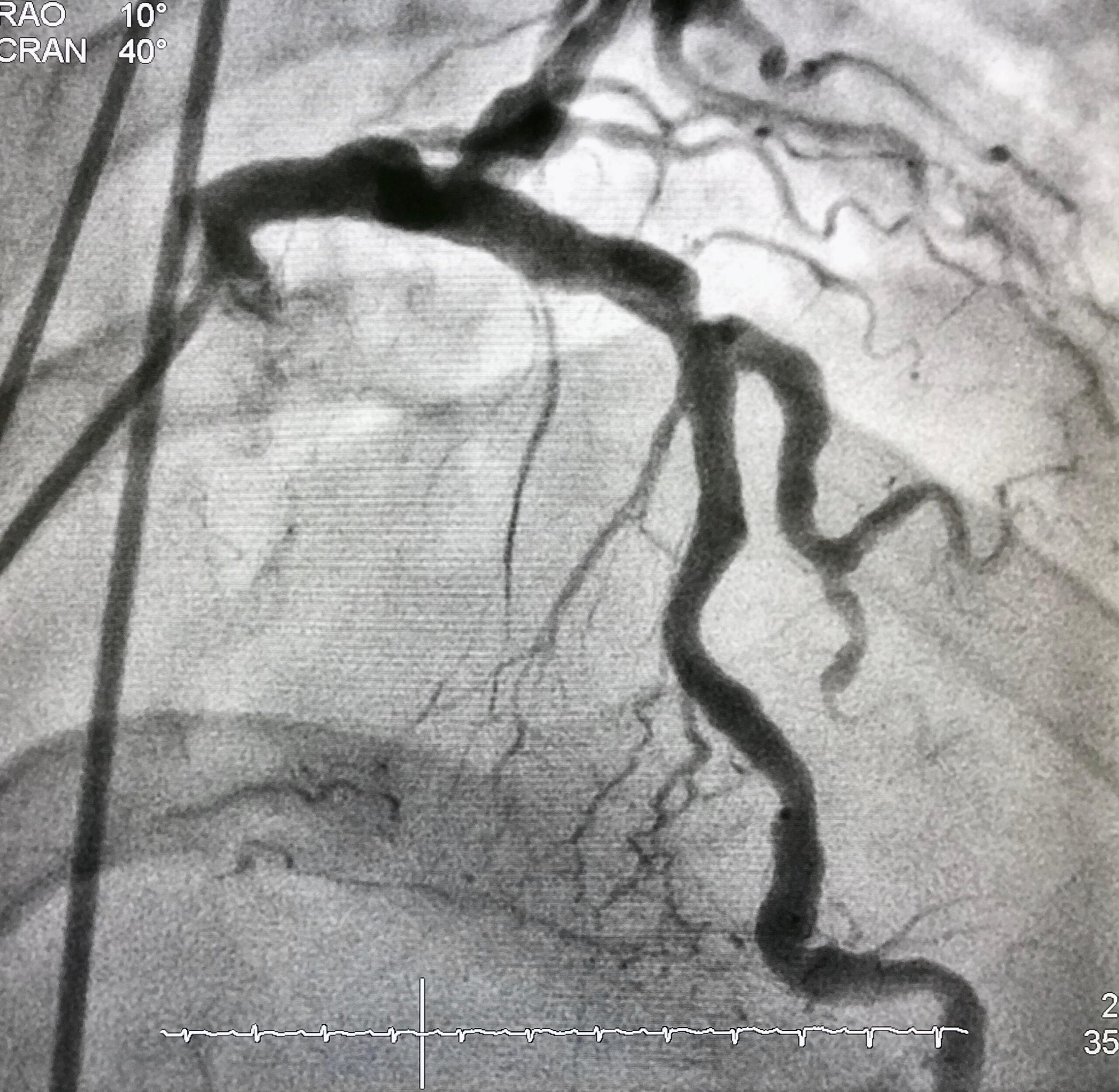Érszűkület vizsgálata a VeinStream Klinikán