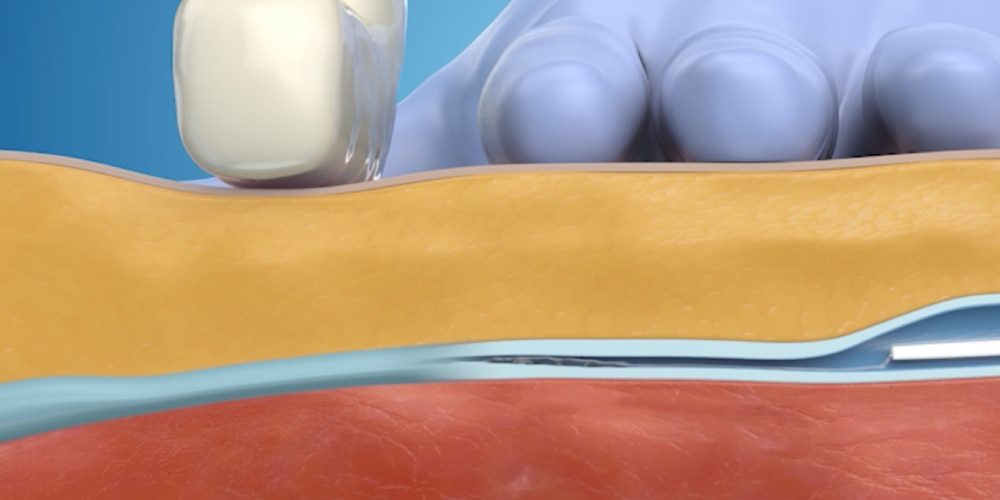 Enyhe nyomás alkalmazása a VenaSeal ragasztásos visszérműtét során.