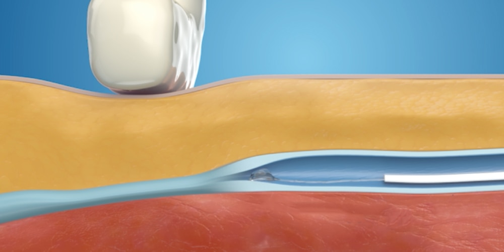 A VenaSeal ragasztóanyag bevezetése a ragasztásos visszérműtét során